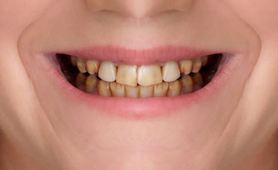 smile-4-1